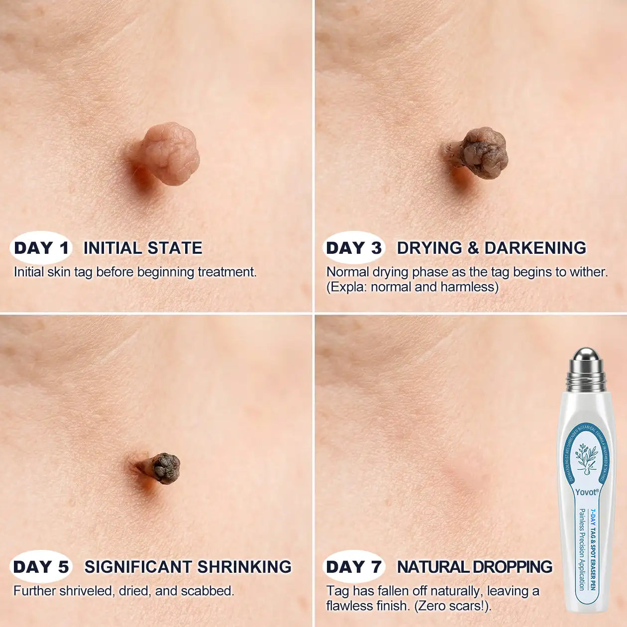 Yovot®🩹🎉7-𝐷𝑎𝑦 𝗧𝐚𝐠 & 𝗦𝗽𝐨𝐭 𝐄𝐫𝒂𝒔𝒆𝒓(Zero Pain, Zero 𝐒𝐜𝐚𝒓𝒔 Rollerball)